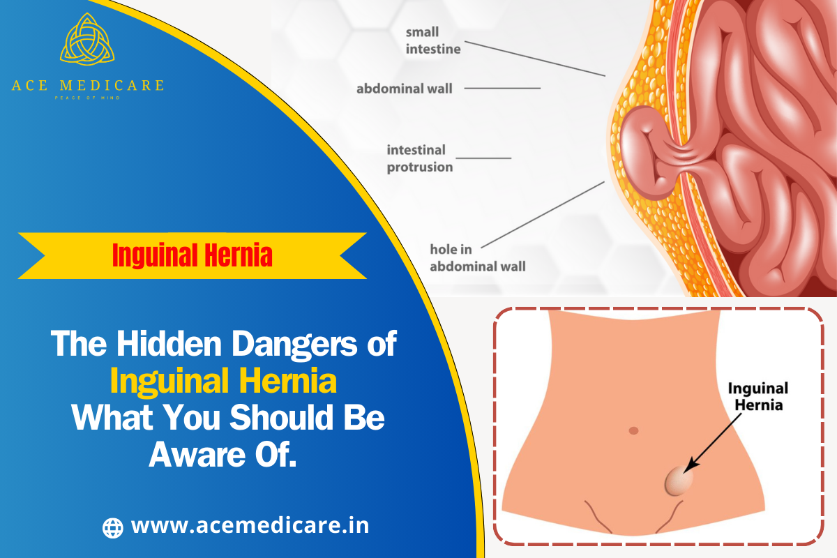 The Hidden Dangers of Inguinal Hernia: What You Should Be Aware Of